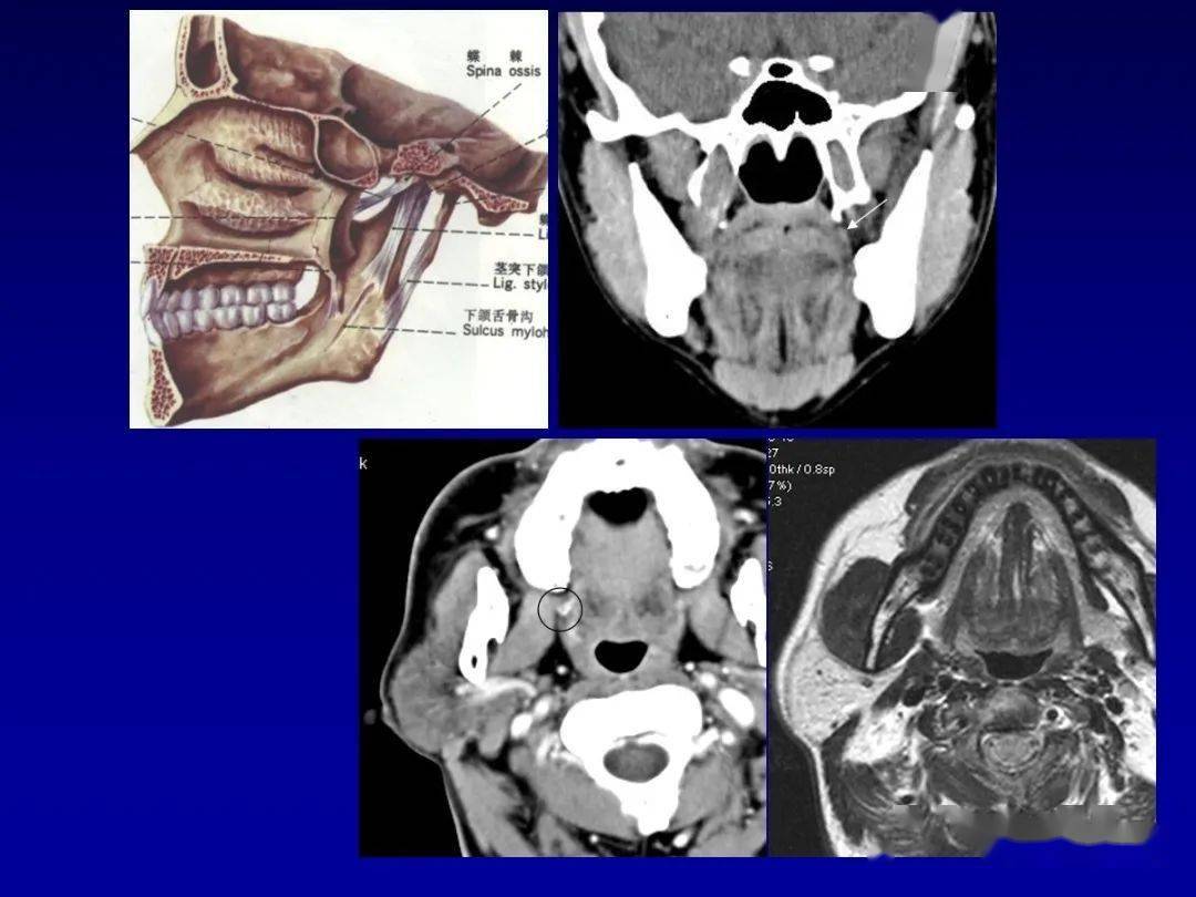 颌面部解剖及其病变的影像诊断