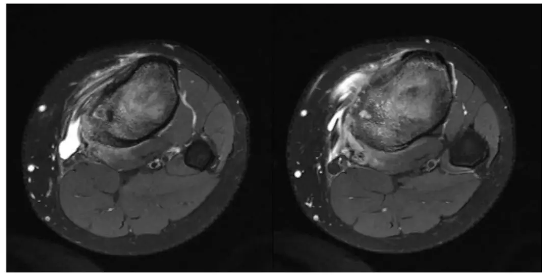 少见的类型:骨样骨瘤的影像诊断,你掌握多少?
