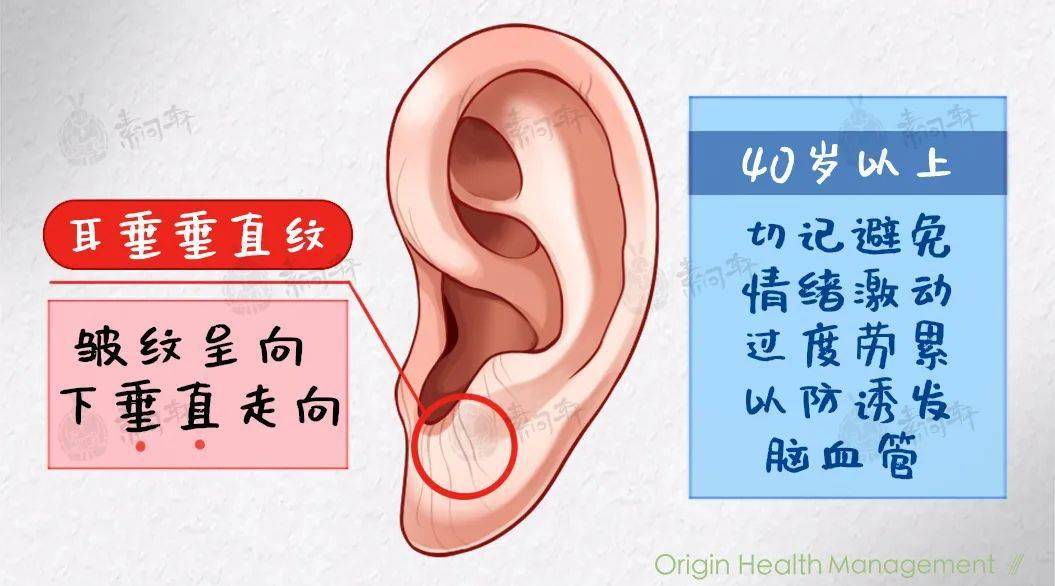 50岁以上,如果耳垂出现一条皱纹沟向下,或者向上, 那就要小心冠心病