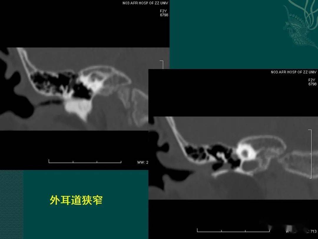 耳解剖及常见疾病影像表现