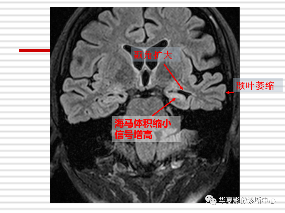 关于海马硬化的影像诊断