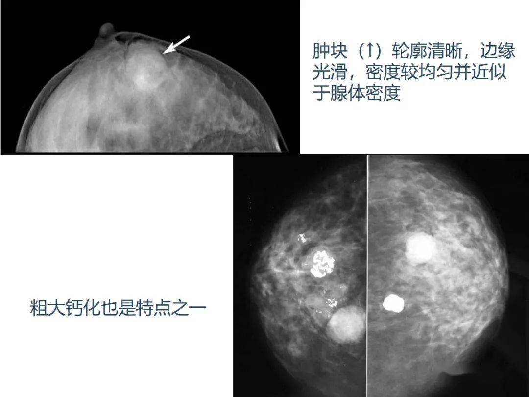图2—230 右腋窝肉瘤肺转移-胸部X线影像学图鉴-医学