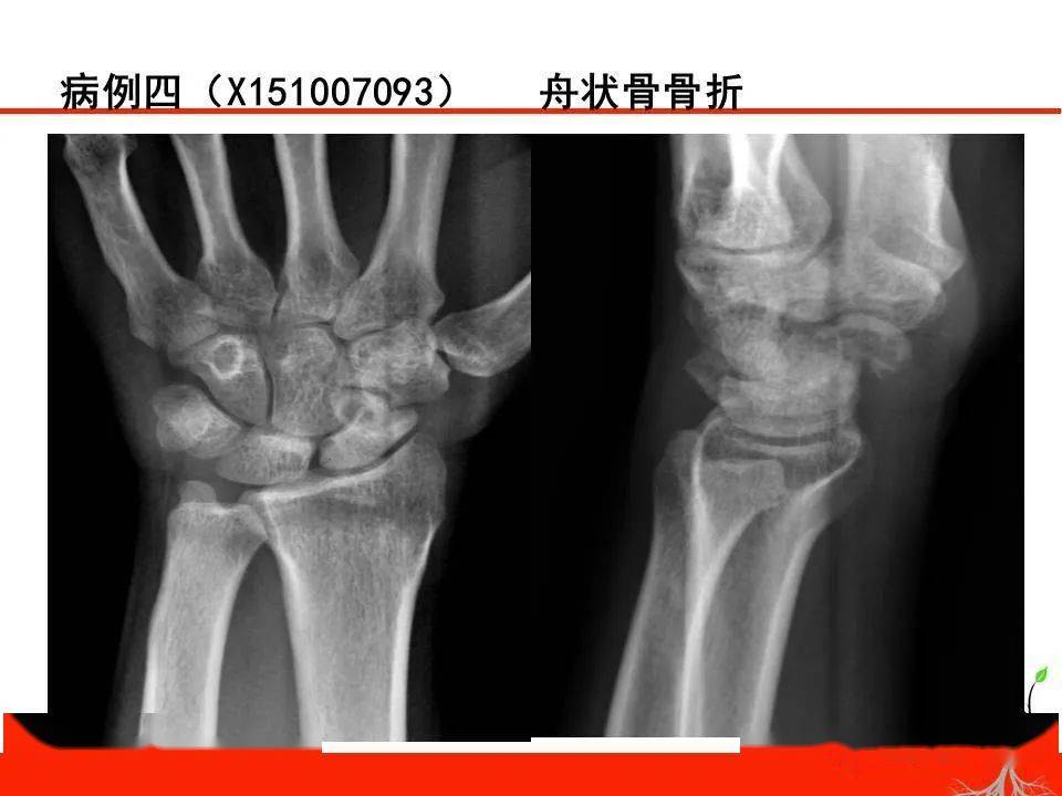 成人腕关节外伤x线诊断