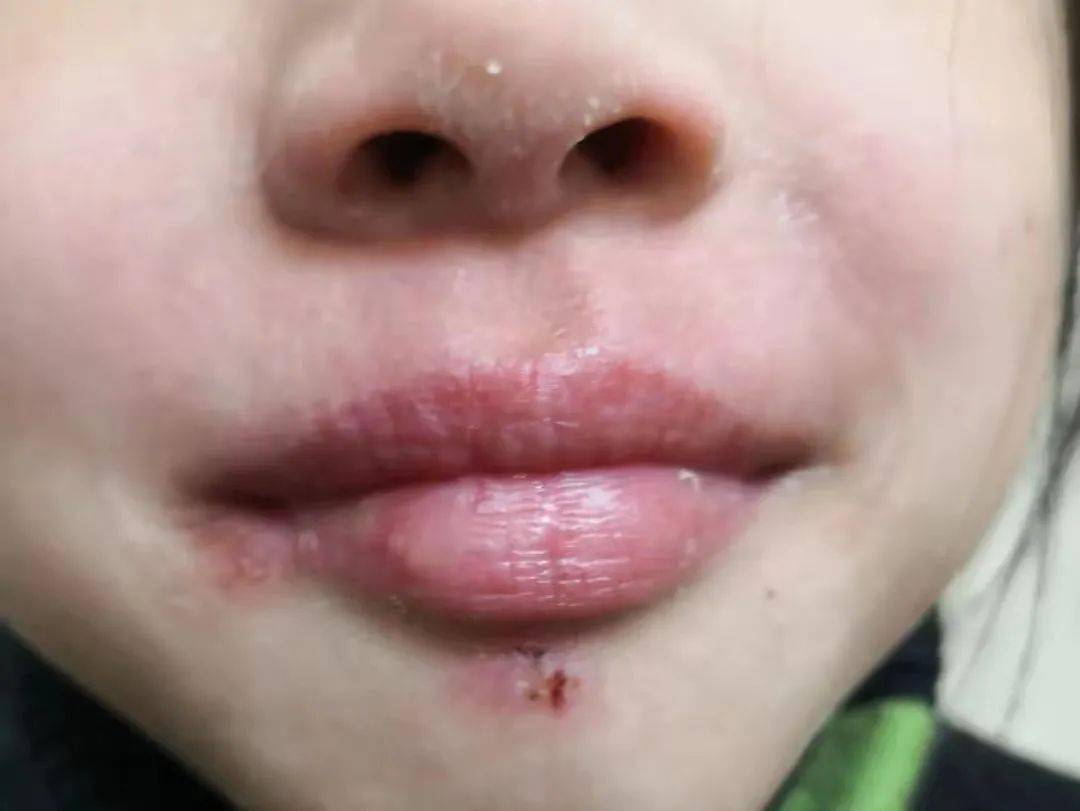 越舔越干,越干越想舔!天气干燥,小心嘴唇被这"不怀好意的亲吻"盯上
