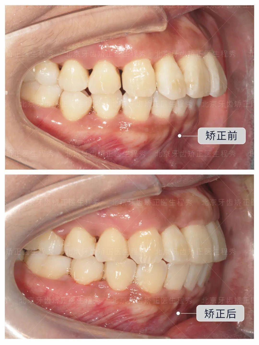 通过关缝和片切解决黑三角问题