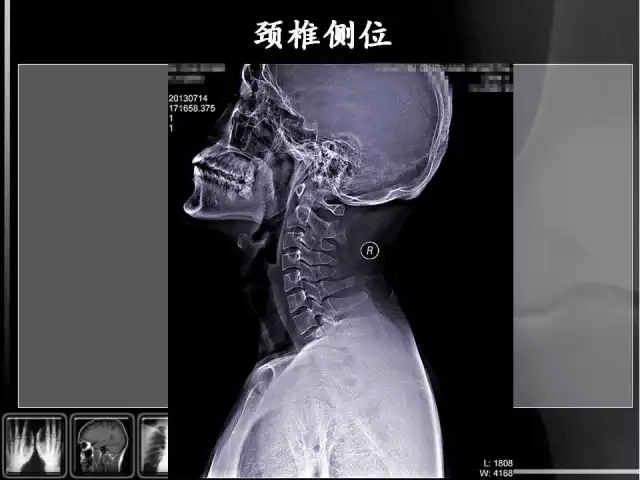 通俗易懂的脊椎x光片读片指南,值得收藏