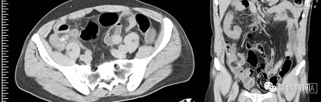 图示阑尾入口处可见粪石,阑尾增粗,外侧壁变薄,回缩,周围见渗出