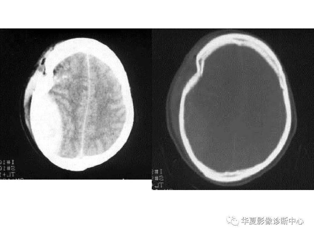 收藏!影像医生必备 | 手把手教你读懂颅脑ct