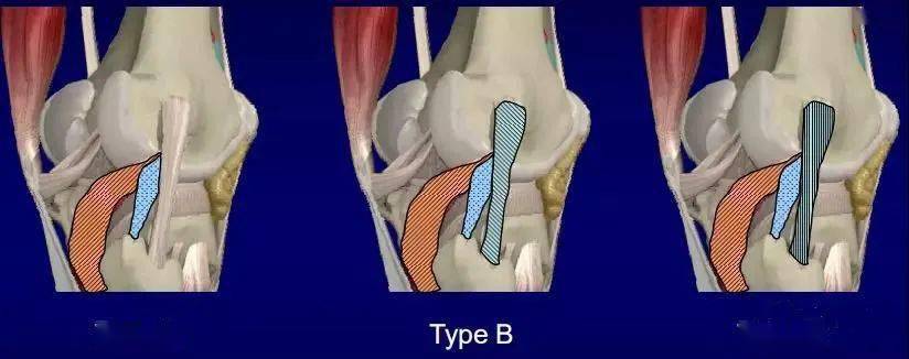a型是单纯的胫骨外旋增加,意味着腘腓韧带和腘肌腱的损伤.