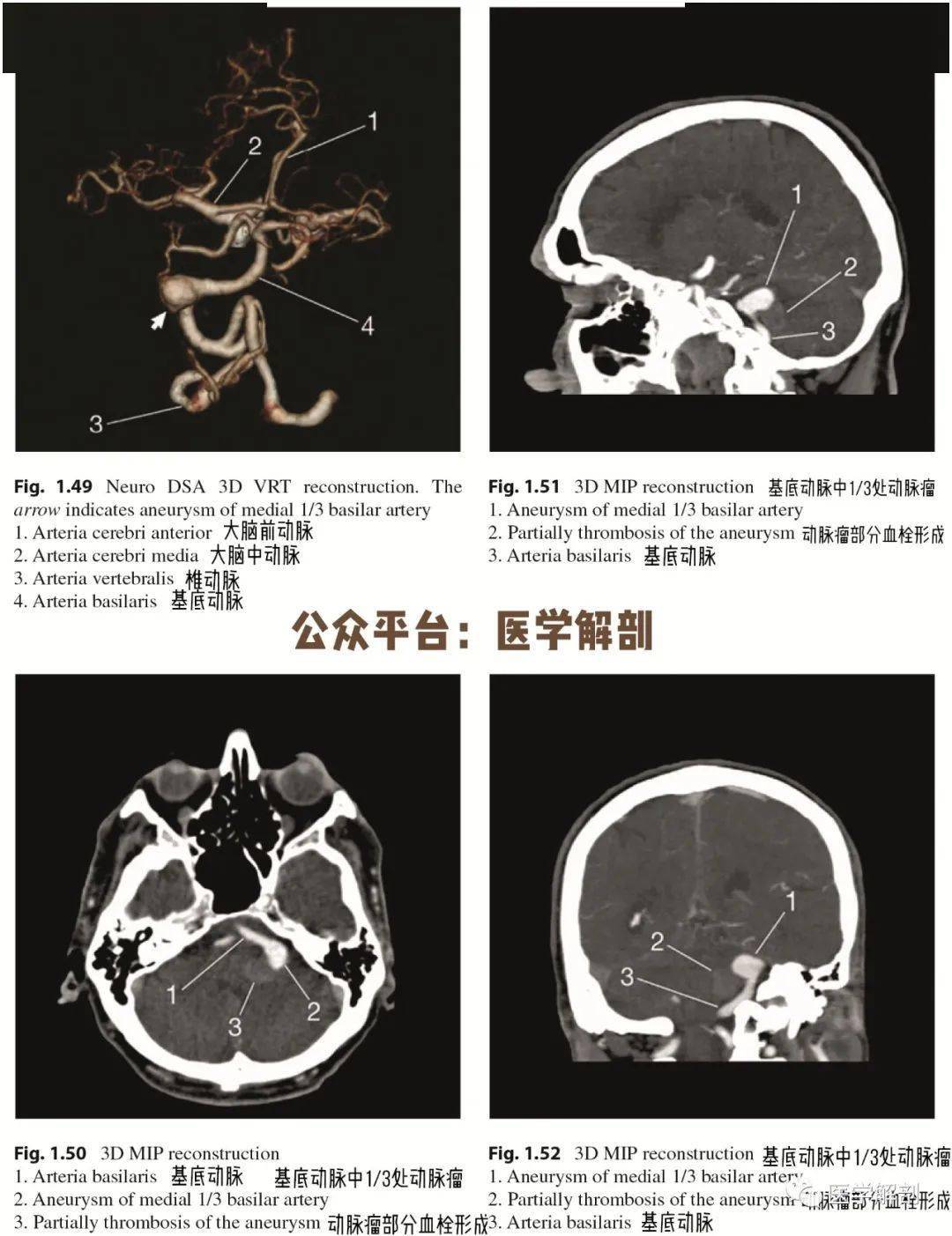 脑cta图谱 | 基底动脉瘤详细解剖及复查