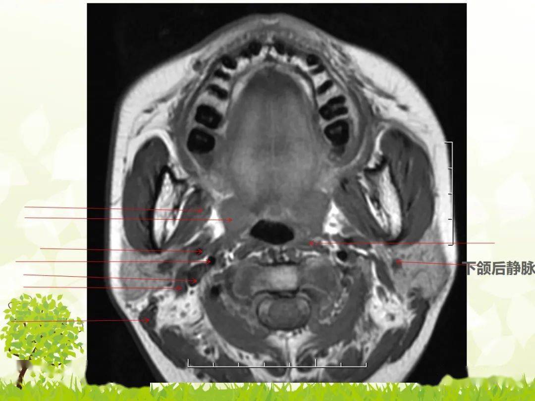 咽旁间隙解剖及常见病变影像表现