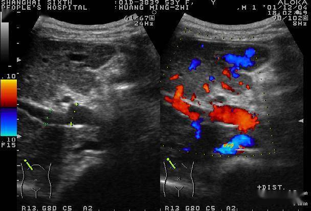 10种肝脏疾病超声诊断_静脉