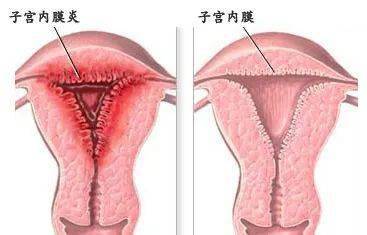 2,子宫内膜炎:可以没有任何症状,需要宫腔镜检查,结合子宫内膜活检.