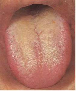 本图患者为流行性感冒后,舌苔淡黄厚腻,胸闷纳呆,提示湿热中阻