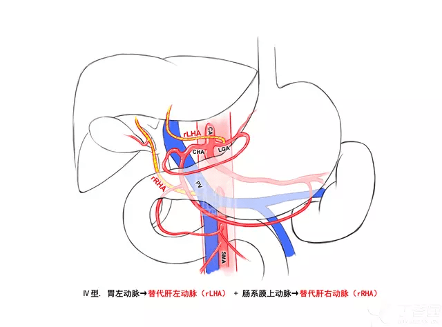 只参与正常同名肝动脉分布区域内一部分血供的变异肝动脉