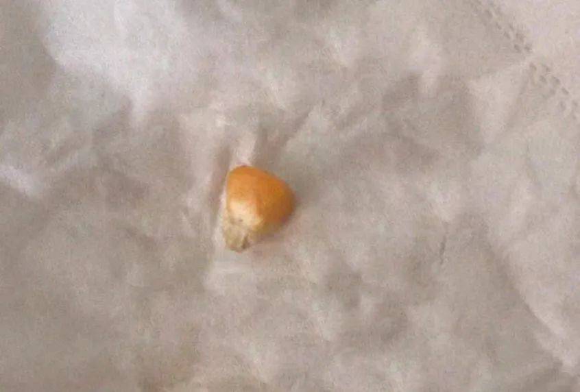 1岁5个月儿童玉米粒进鼻腔,儿童耳鼻喉医生一分钟急救