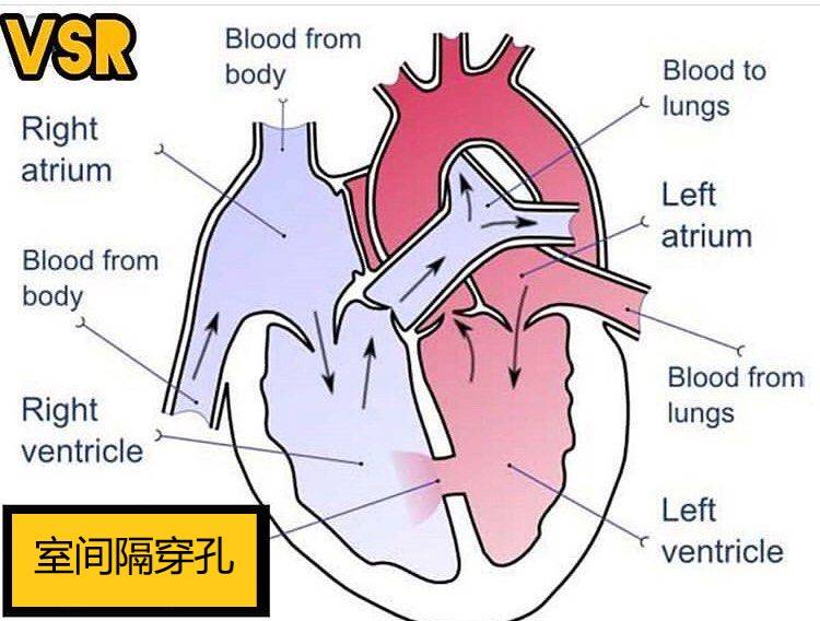 心梗后一周内现呼吸不畅血压低下当心室间隔穿孔上海十院成功救治心梗