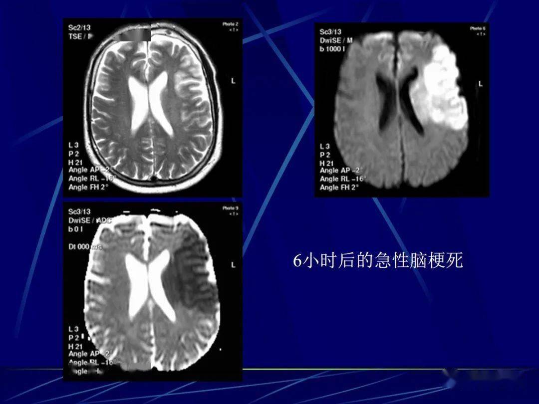 头颅mri中不同序列dwi和adc的区别