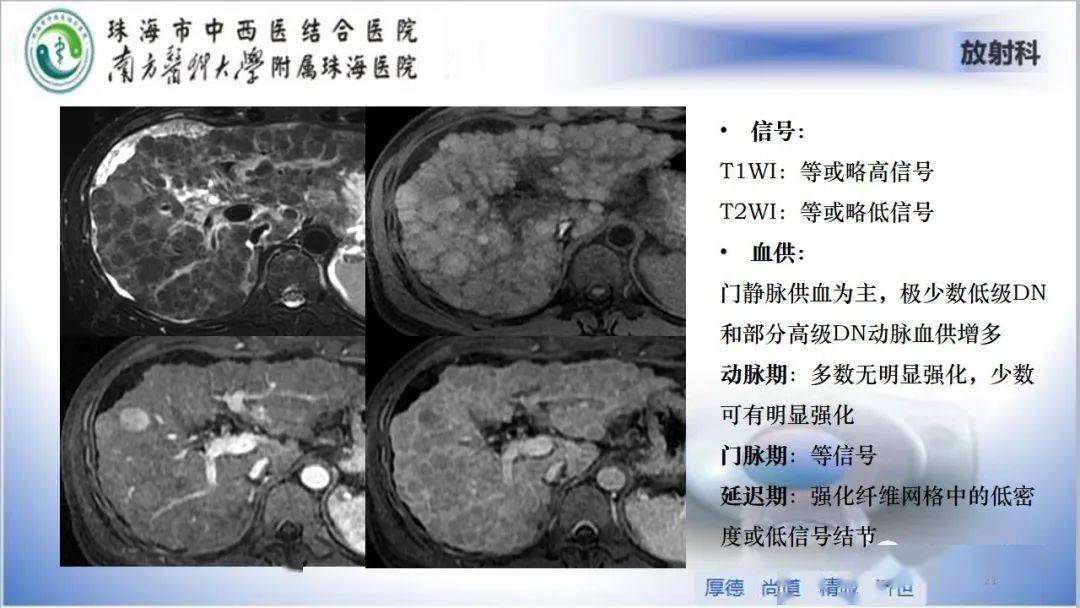 肝脏影像分段及肝硬化结节mri诊断