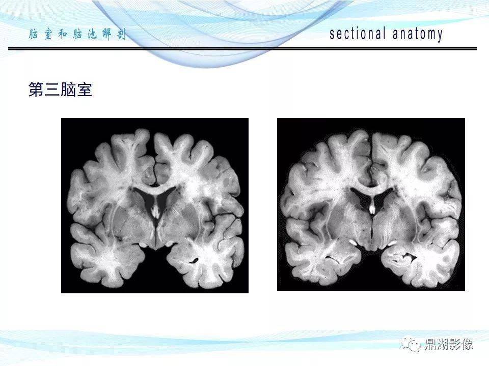 超全详解:脑池和脑室断层解剖