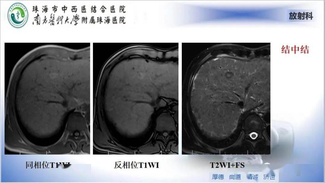 肝脏影像分段及肝硬化结节mri诊断