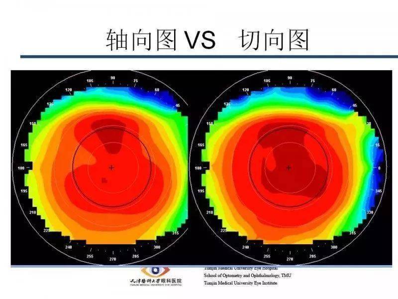 【眼视光】 角膜地形图阅读及基本使用