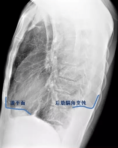 侧位片可见左侧肋膈角变钝,少量胸腔积液 病例2
