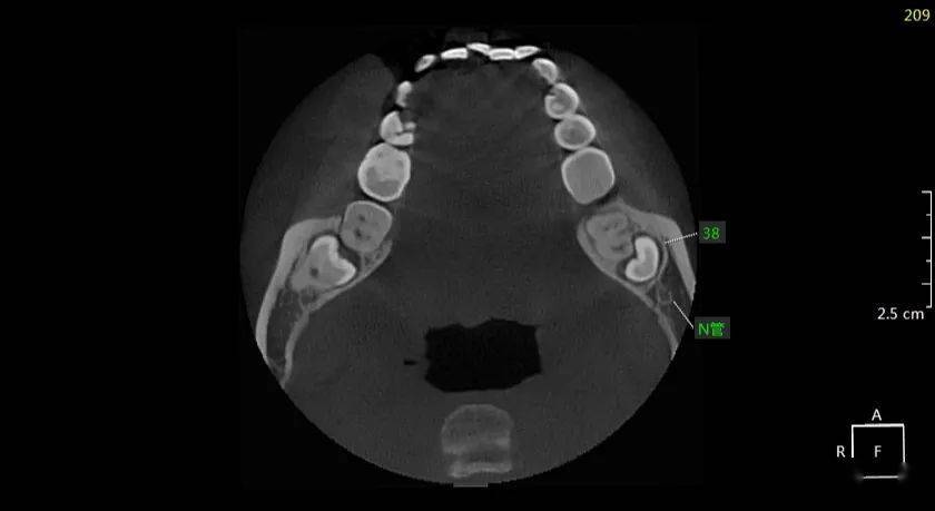 ct示:38倒置倾斜阻生,双根,牙冠距37远中根尖处较近,与下颌神经管上
