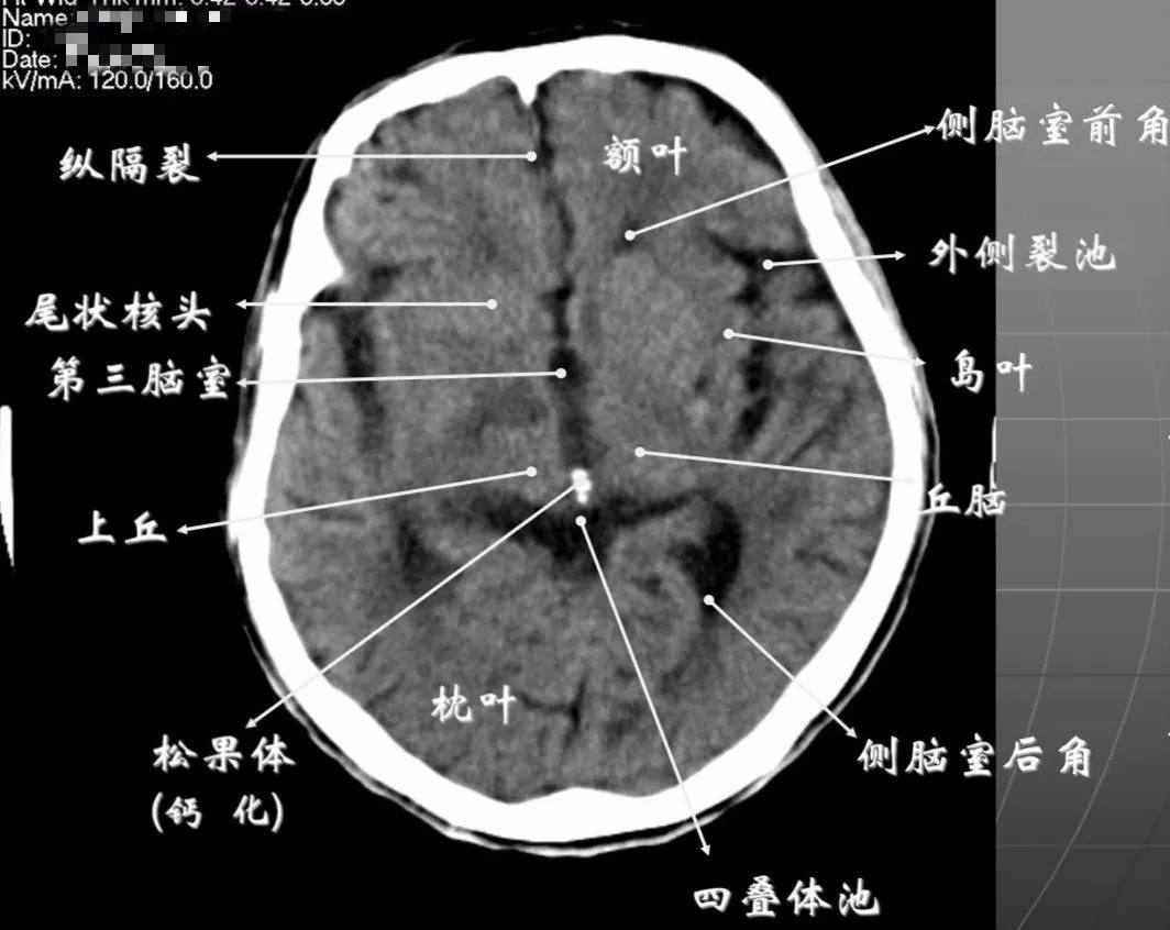 简明又详细的头部ct读片详解,收藏_脑室