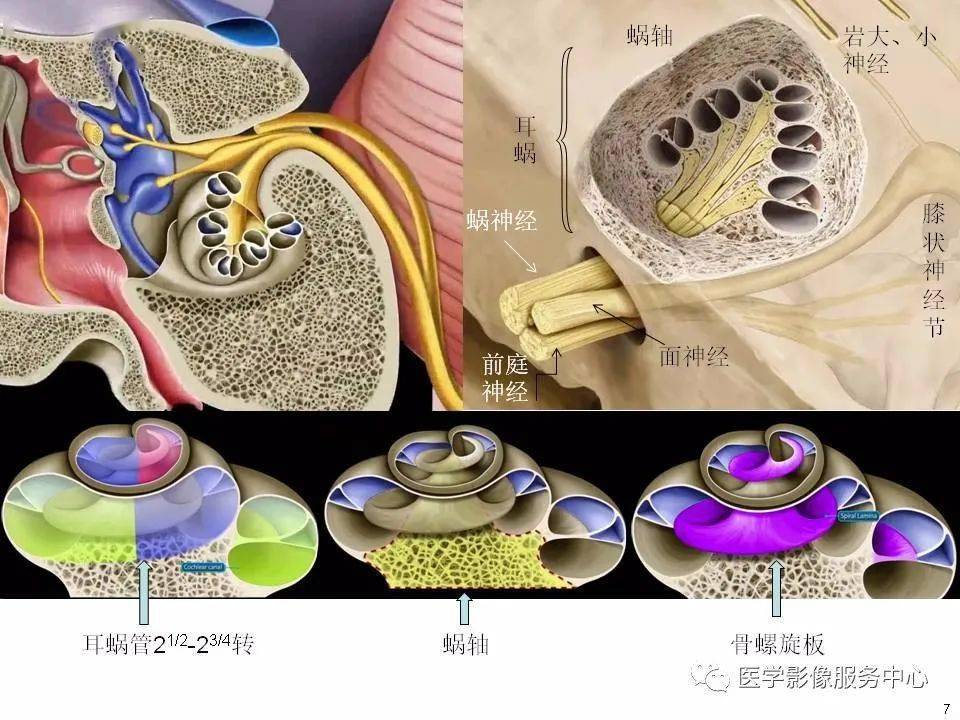 本文目录 第一部分:耳蜗解剖  第二部分:内耳畸形分类,主要基于ct