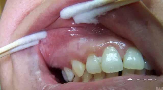 面部及四肢发生多发性较大皮脂腺囊肿是本病的一个特征.