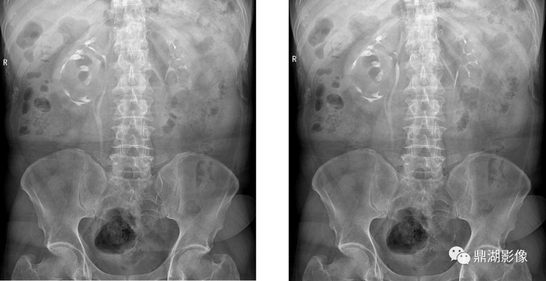 影像技术 | 静脉肾盂造影_输尿管