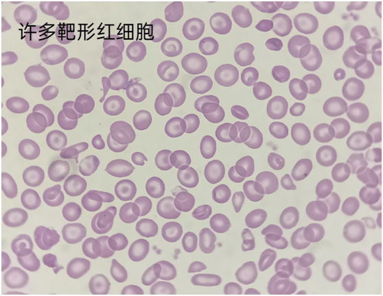 先给大家看看正常血涂片红细胞的形态是怎样的.