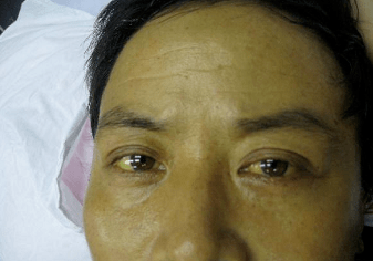 肝病前期不痛不痒,如果出现这两个情况,你要注意就已经是小肝癌