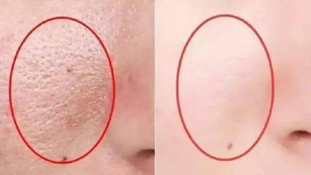 插秧式大毛孔也能变成婴儿肌