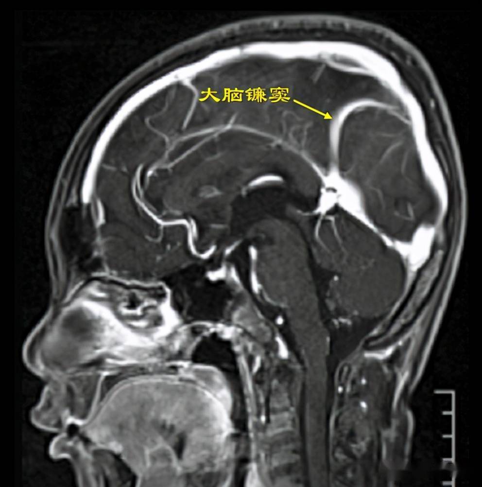 横窦接受来自岩上窦,枕叶桥静脉和小脑的静脉引流,有时板障静脉和迷路