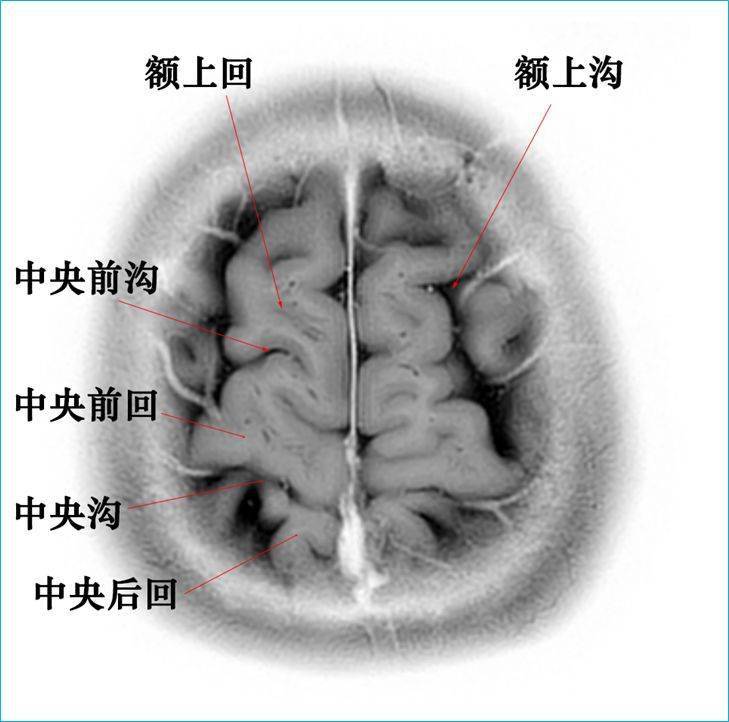 影像必备高清颅脑mr断层解剖图谱