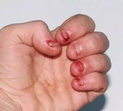孩子频繁吃手咬指甲一个月后他得了这种病
