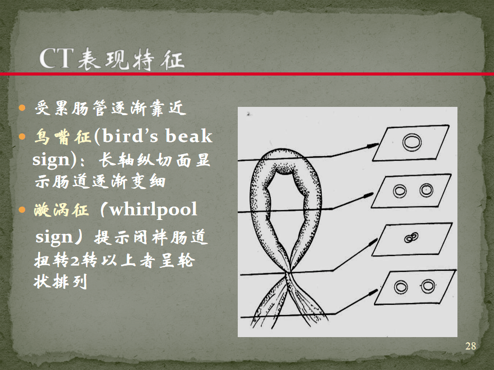 ct入门 | 肠梗阻的ct影像诊断