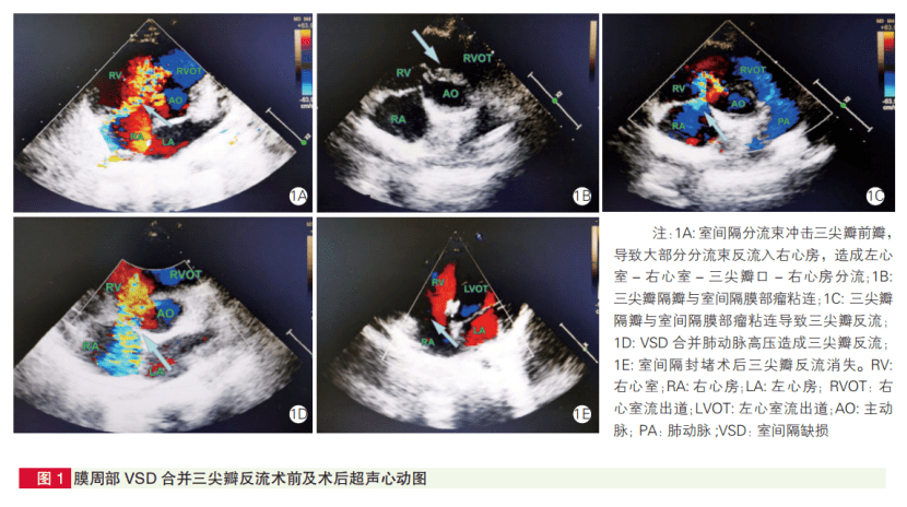 室间隔缺损合并三尖瓣反流,也可介入治疗!河北医大一院研究