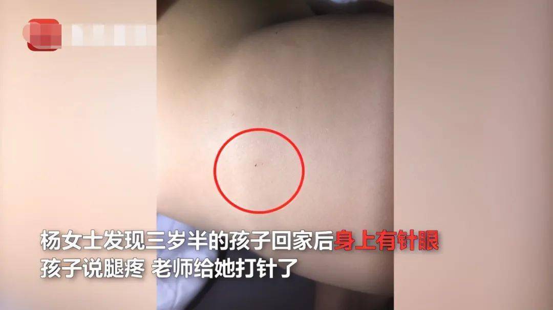幼儿园3岁孩童身上现29处针眼:老师在我身上打针了