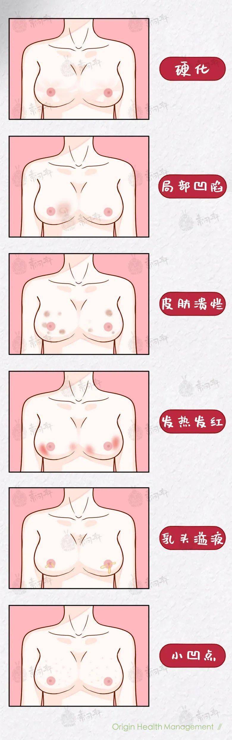 女性乳腺癌发病数首超肺癌:别生气了,真的要命_乳房