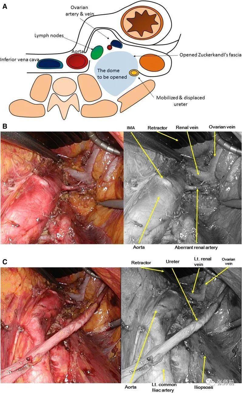 腹腔镜肾静脉下腹主动脉旁淋巴结切除术:左侧穹隆形成