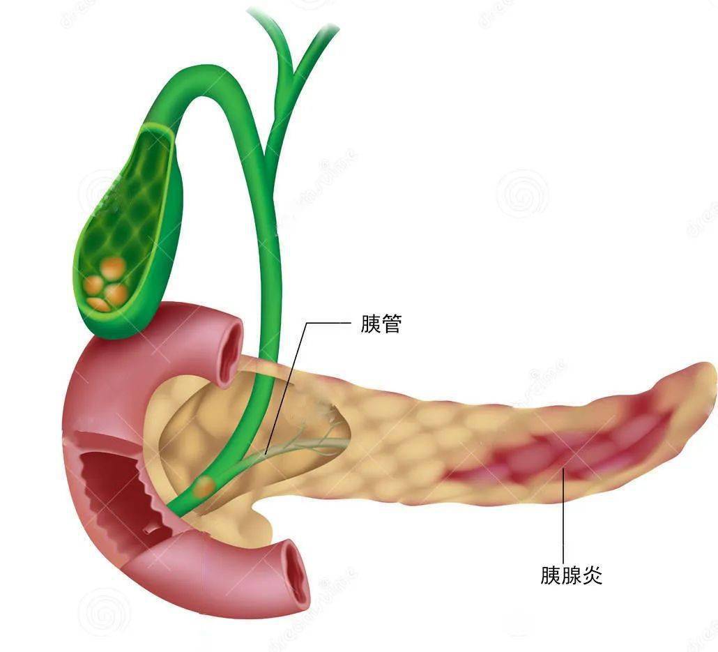 胆管交界处狭窄或梗阻,胰液流出受阻,进而形成胰管内压升高,导致胰腺