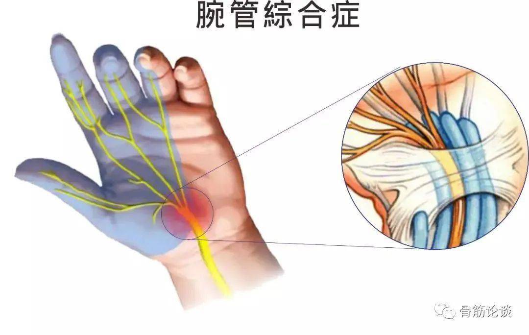 其实"鼠标手"在医学上被称之为"腕管综合征".