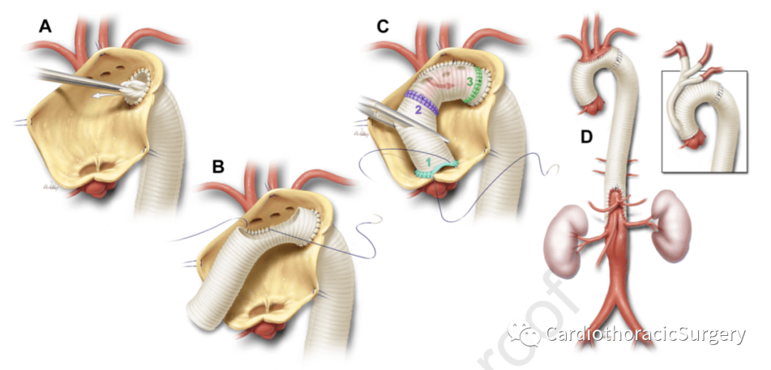 jtcvs丨应用逆向象鼻技术分阶段治疗广泛胸主动脉瘤23年经验