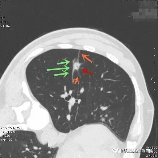 检查发现肺实性结节怎么办个人版实用指南