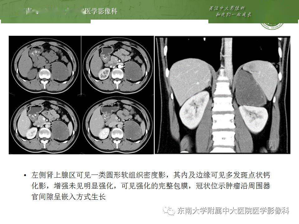 腹部肾上腺皮质癌影像诊断