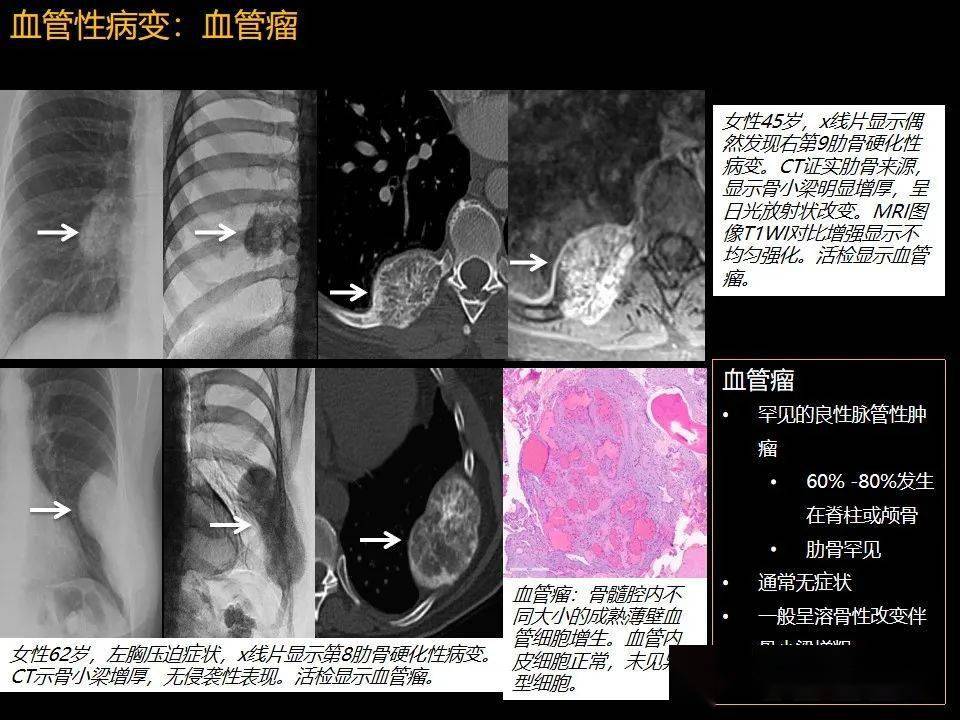 肋骨肿瘤,肿瘤样病变及获得性非创伤性病变的影像诊断