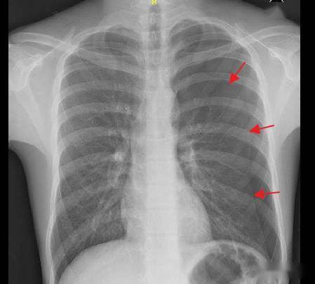 气胸时如何大体判断肺被压迫的程度?